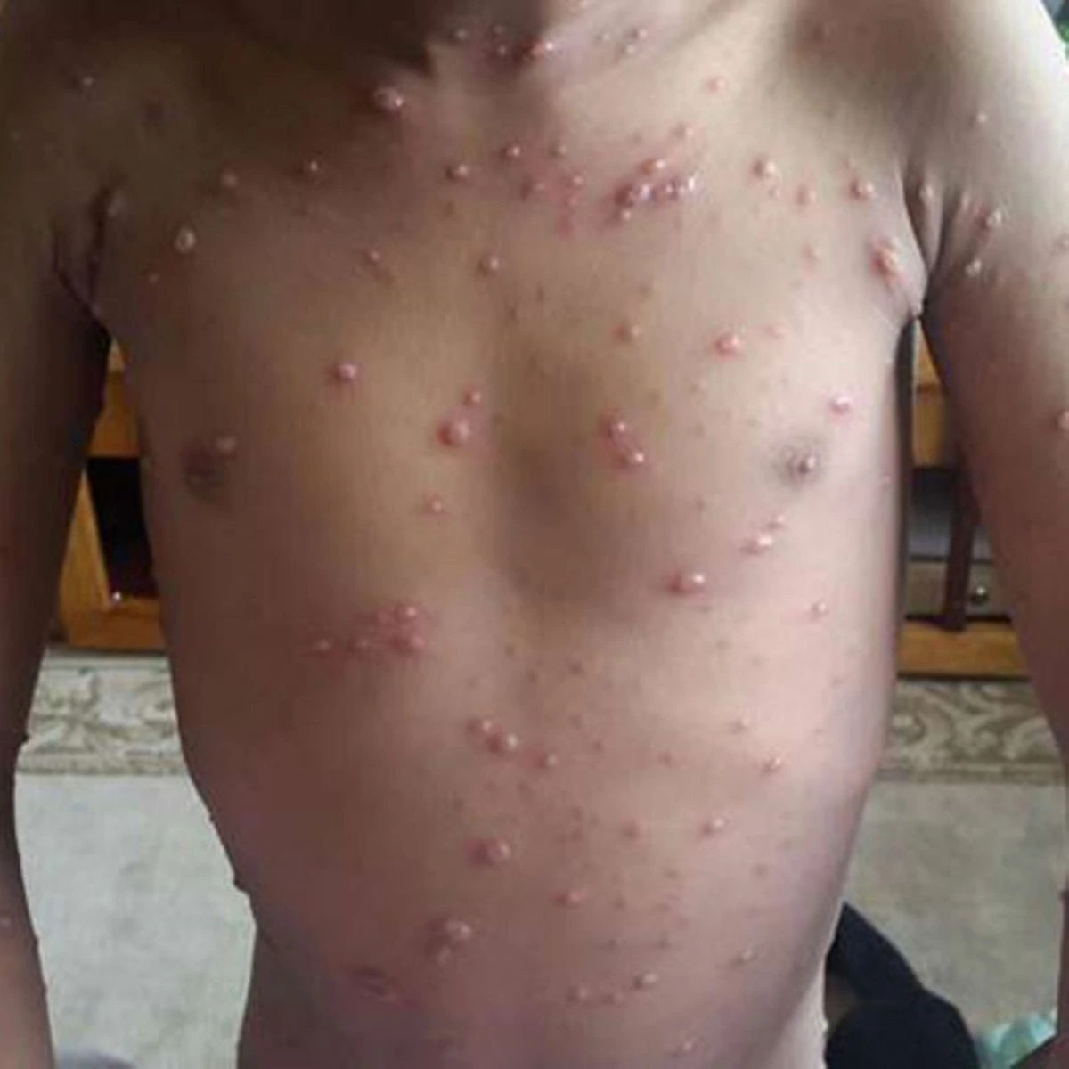 Read more about the article Gentle Home Care for Chickenpox Relief