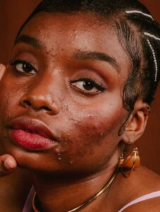 Read more about the article Natural Ways to Clear Acne at Home