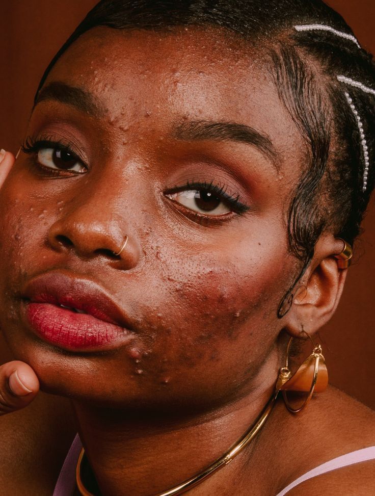 Read more about the article Natural Ways to Clear Acne at Home